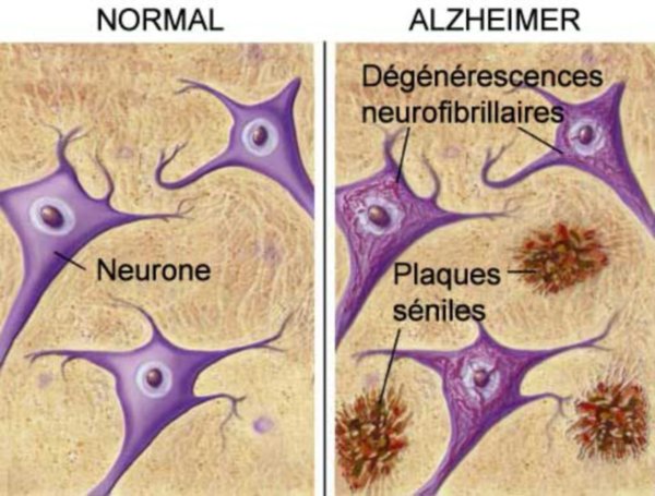 Alzheimer-Cerveau-2